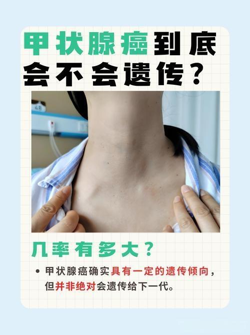 河南郑州一家庭5口人中4人患癌，三兄妹同患甲状腺癌，其父也因该病切除甲状腺。医生