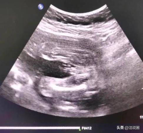 陈女士怀孕后找熟人做彩超，在她再三要求之后，熟人出于好心，告知是女儿。她因此做了