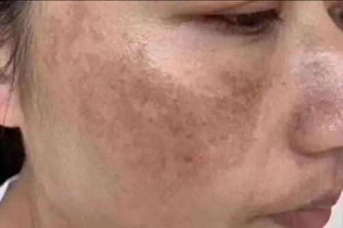 想皮肤干净不长斑？先益肾养肝！中年人防斑，根源在内里
我是陈大夫⚠️温馨提醒：内