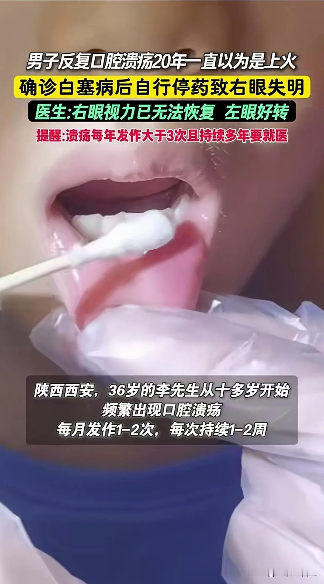真出大事了！

陕西，一位36岁的李先生，从十来岁开始嘴里就老是长溃疡，一个月一