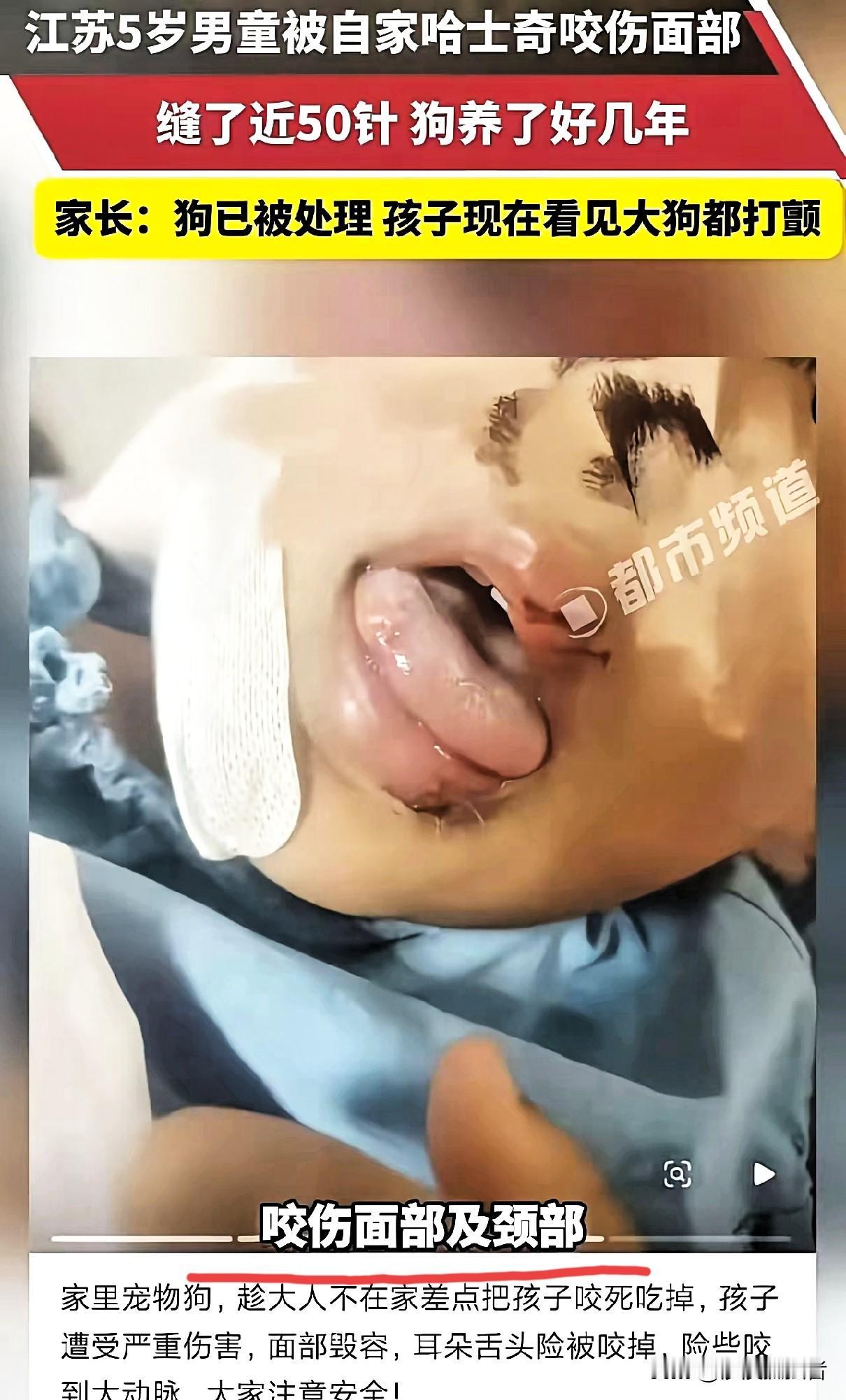 这下养狗的都被干沉默了！江苏，5岁男童被自家哈士奇咬伤面部，缝了近50针！孩子妈