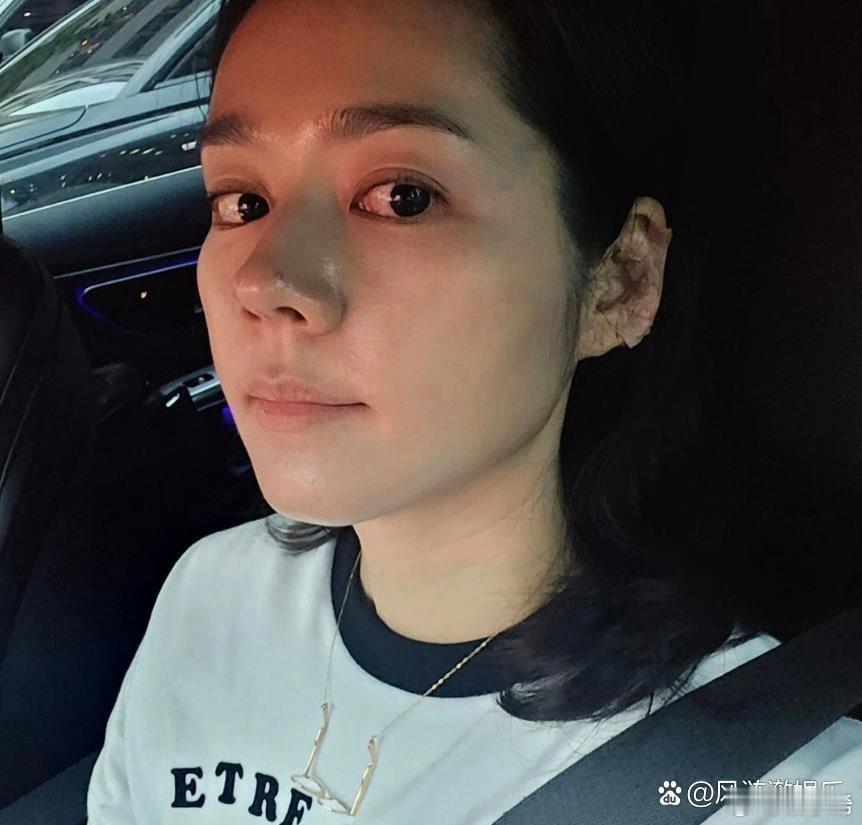 韩佳人自曝最近状态不怎么好，所以接受了放血治疗，女神要好好保重身体。 ​​​