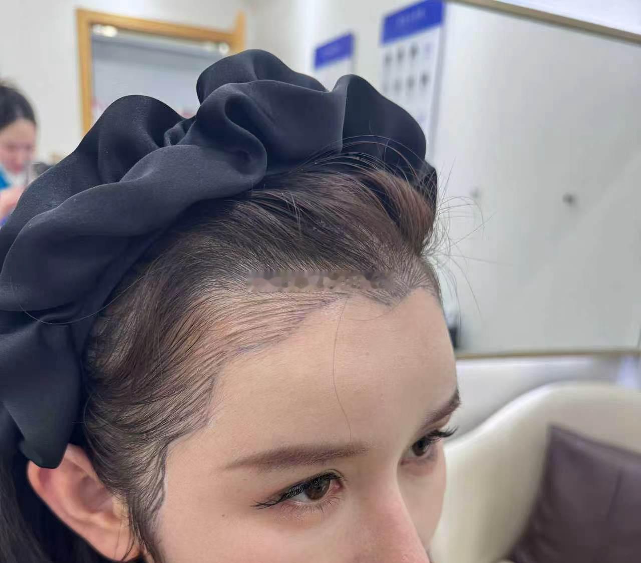 一转眼发际线9个月啦，都差点忘了之前什么样，我觉得这个就是最有性价比 变精致更美