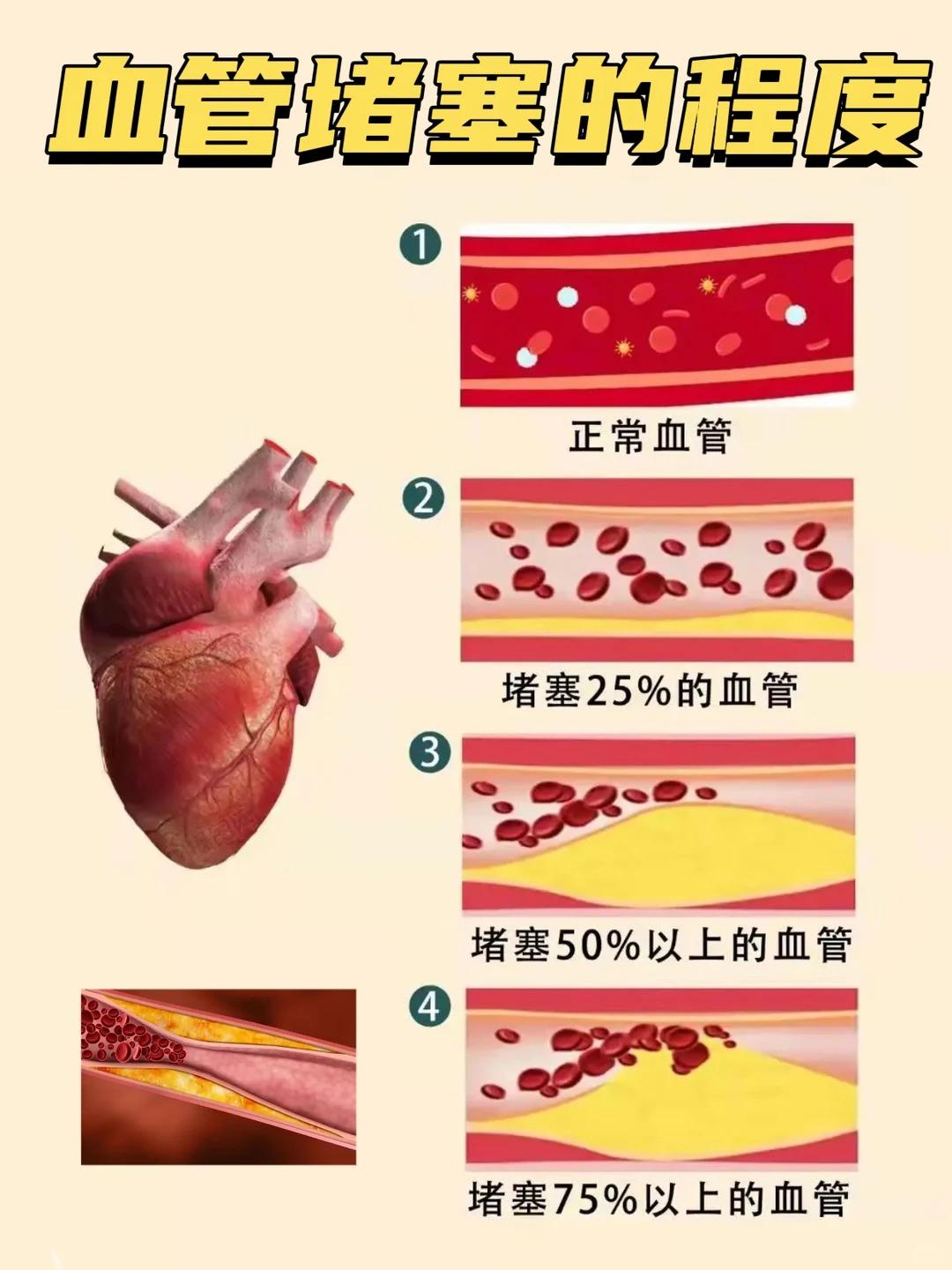 💥血管堵，百病生！这些血管“杀手”快远。今天来聊聊我们身体里的“生命...
