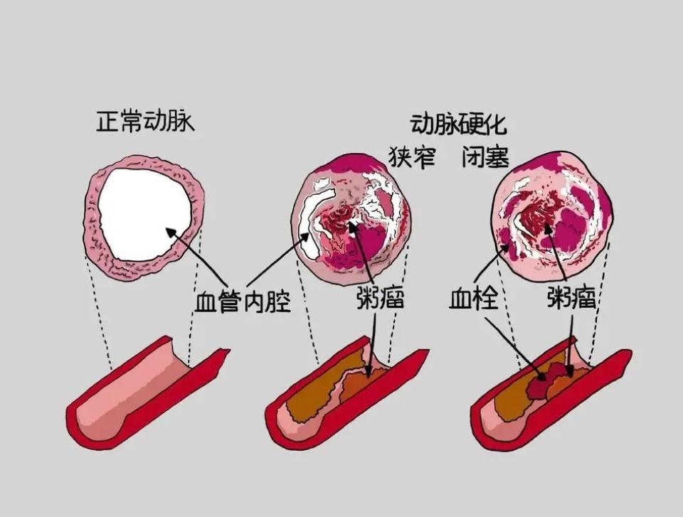 血管堵塞怎么办，平时应该注意什么? 1. 坚持运动坚持运动可以促进血液循环，降低