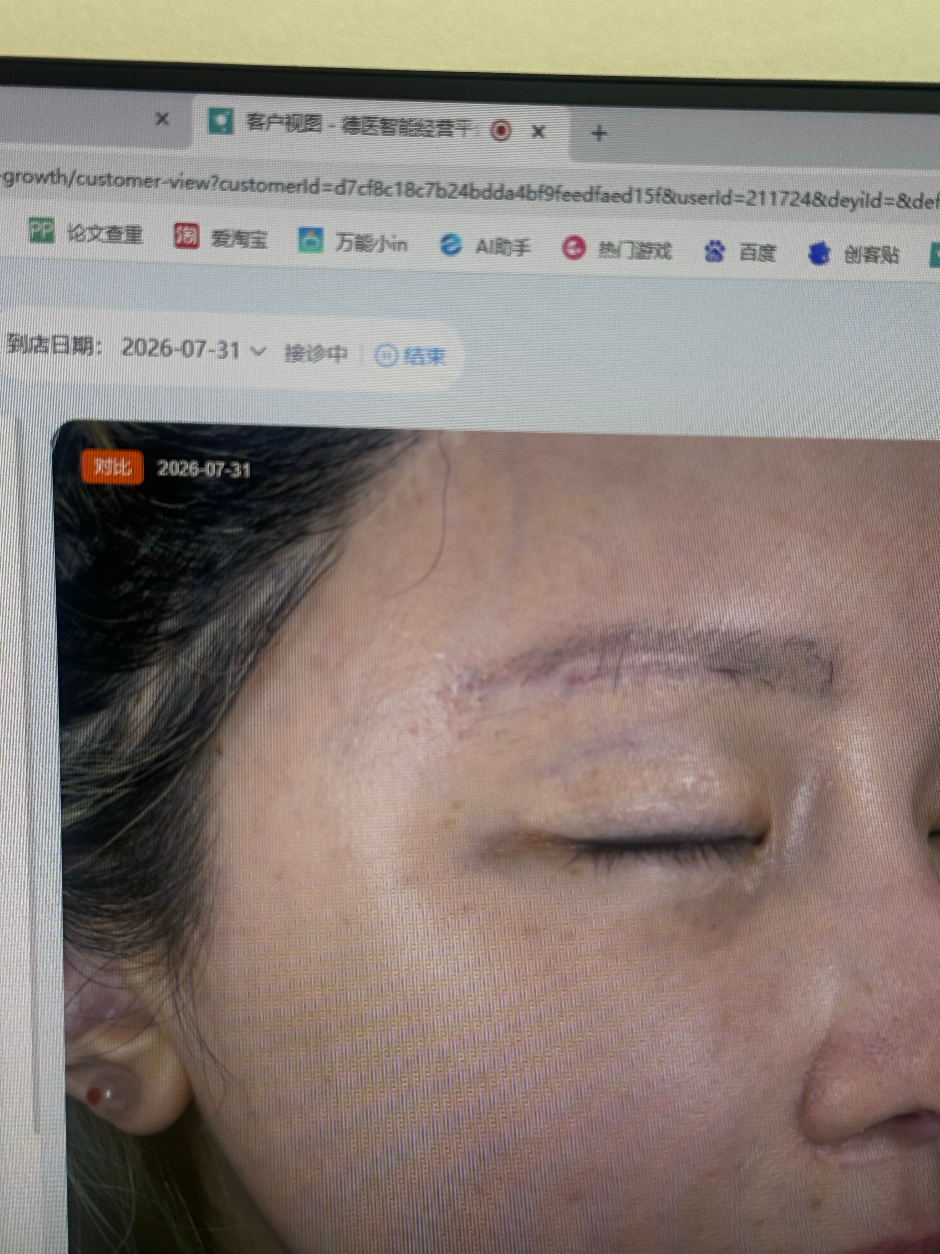 就是眼周这种打光+仔细看会有的褐色斑，昨天问了海栗医生说有浅层斑有深层斑还有扁平