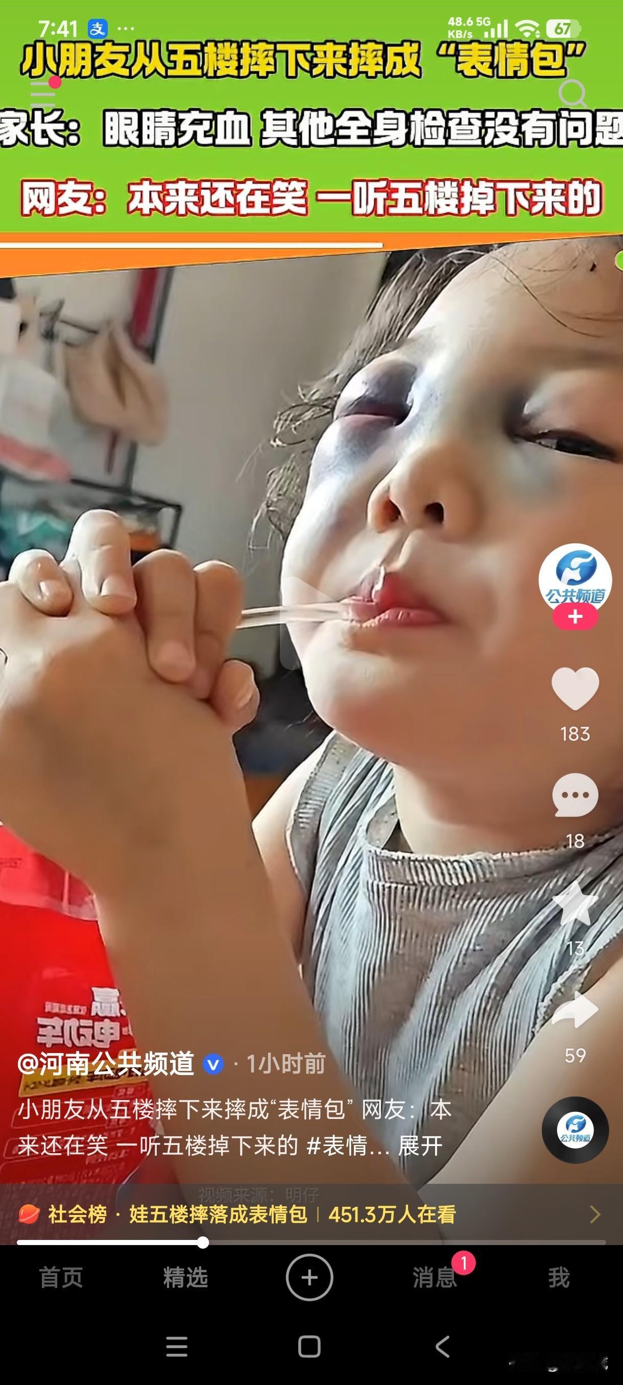 第一眼看到这个摔的鼻青脸肿的女娃差点把我笑死，我以为她是调皮捣蛋自己摔的，谁能想