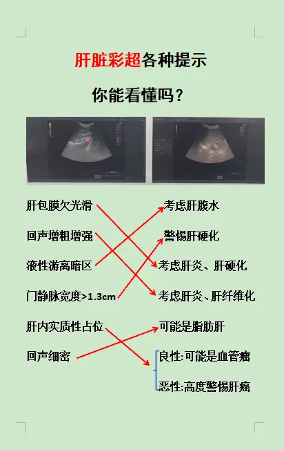乙肝 肝硬化 肝癌 肝纤维化 肝病教授陈士俊