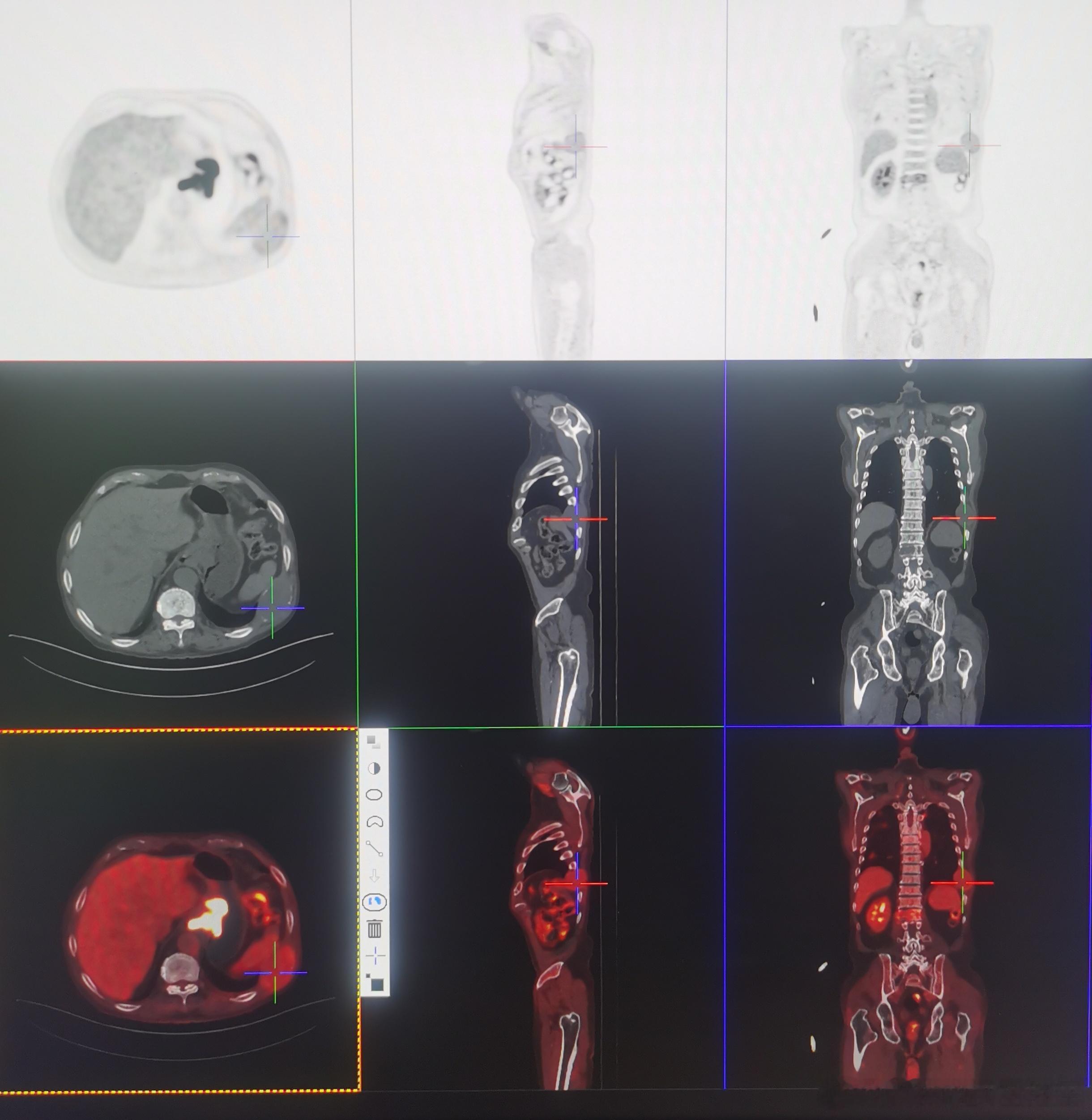 PET/CT比常规CT和核磁共振的优势在于全身无间断连续显像，发现肿瘤更全面，有