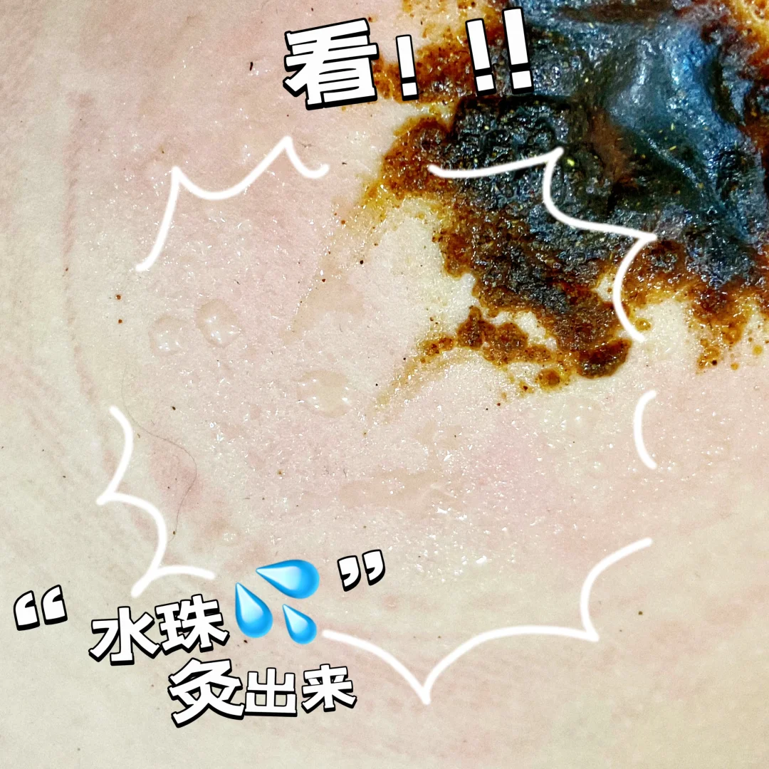 夏至后 孩子如何艾灸