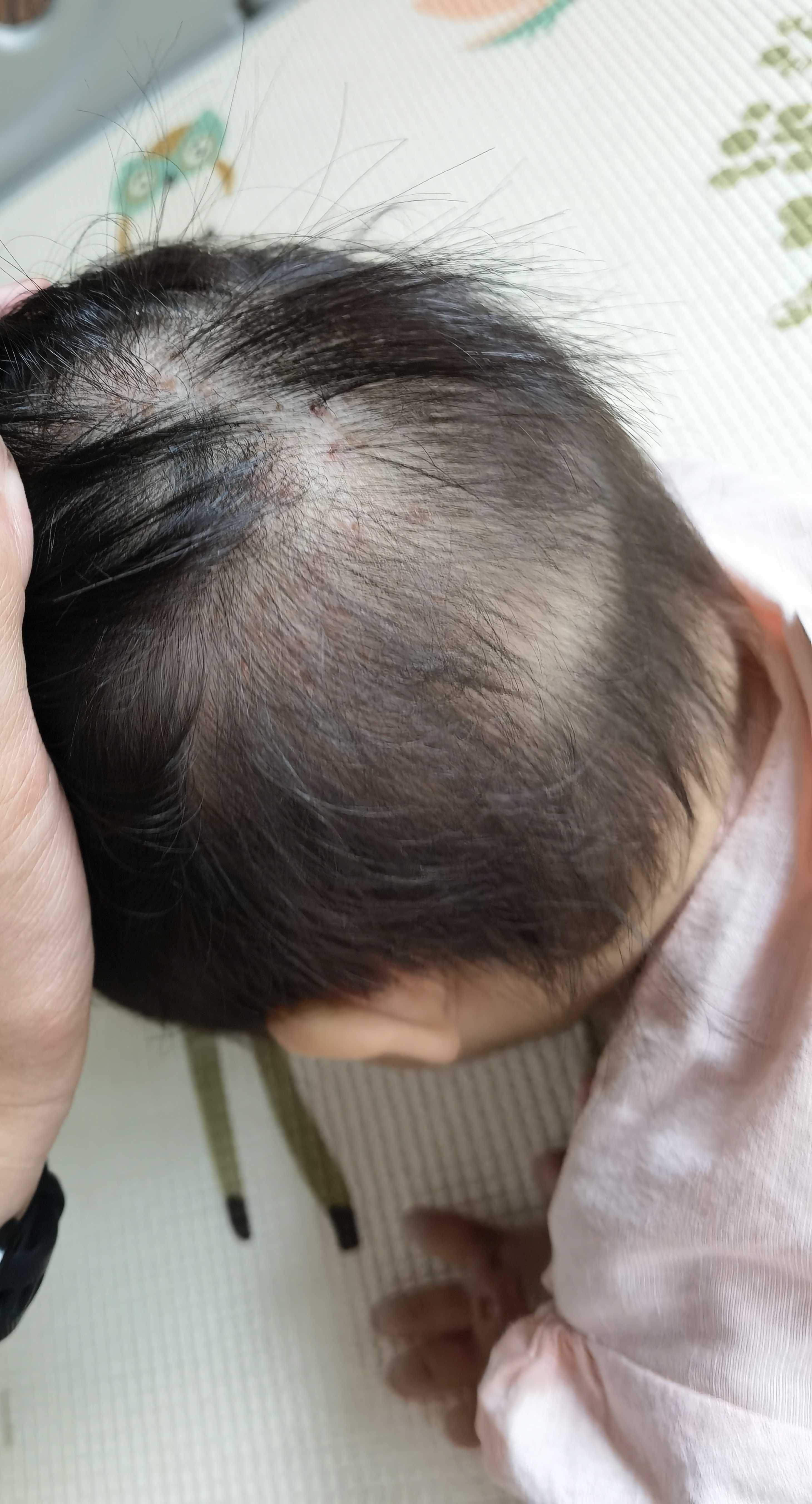 #宝妈咨询# 健康群长沙宝妈：请问儿童手足口会发到头上吗？我们家8个月妹妹还没有
