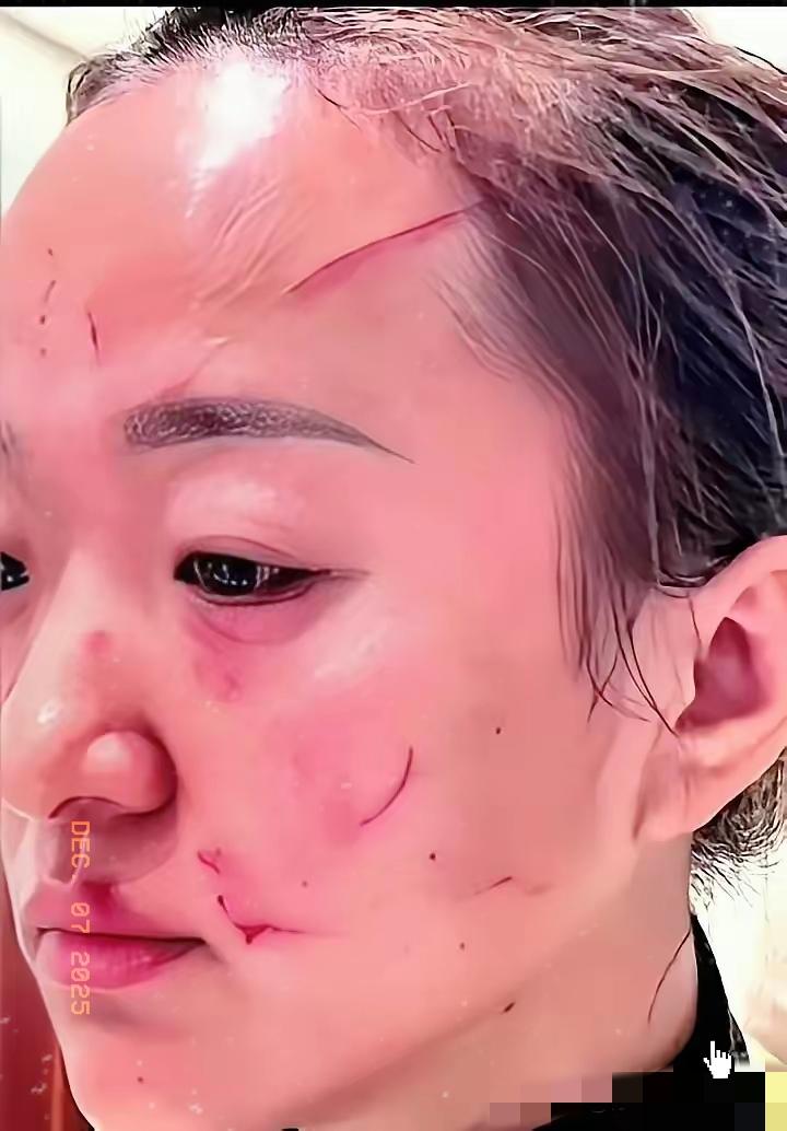 宁波这事儿，看得人心惊肉跳。
儿媳妇脸被婆婆挠得全是血印子，赔了5万块，一家人搬