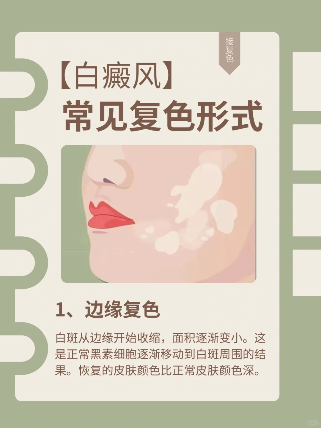 白癜风常见的复色形式