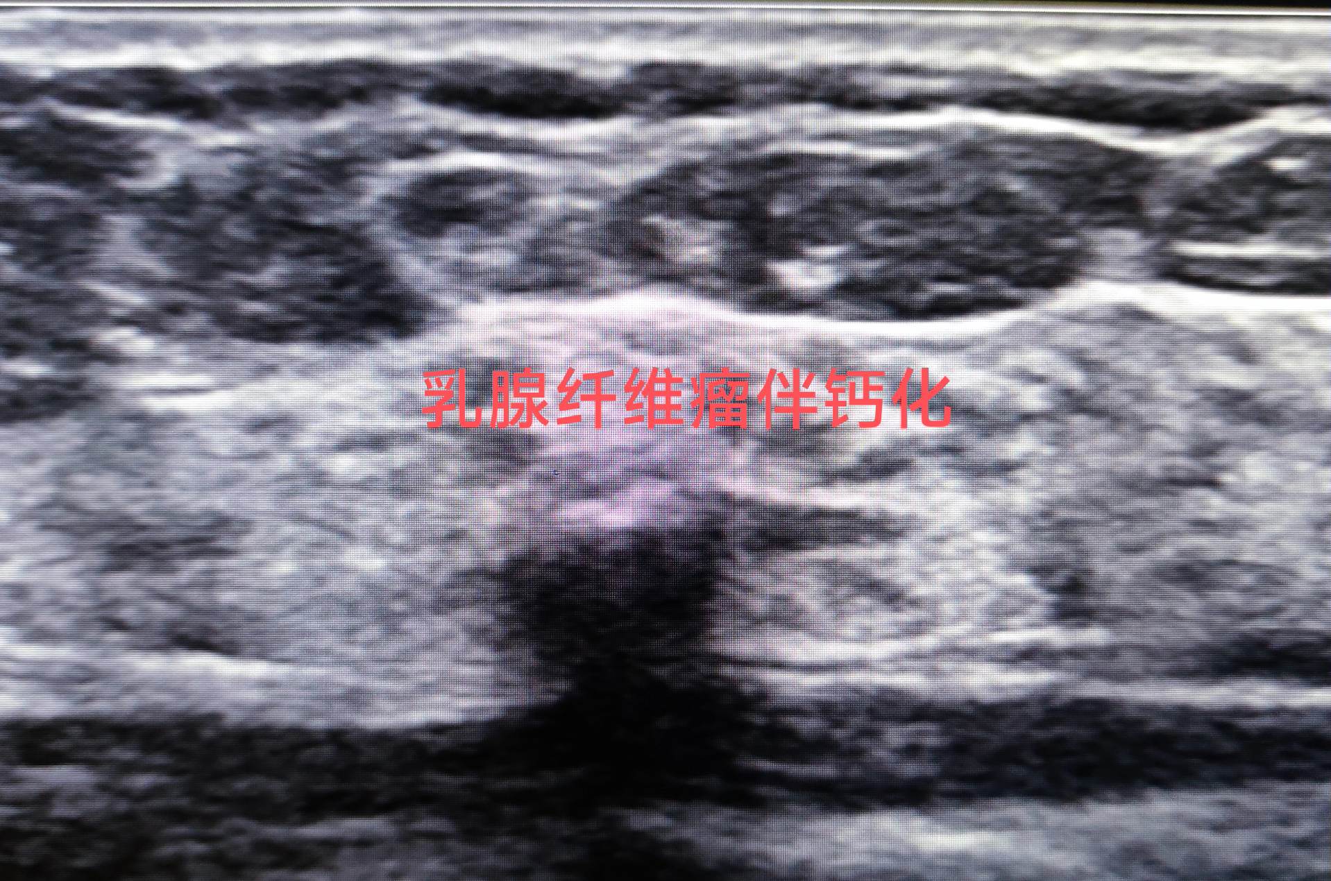 乳腺纤维瘤。伴钙化
随访6年