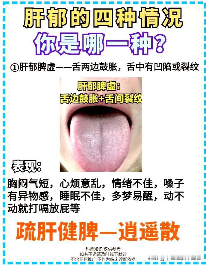 肝郁的四种情况总结全了，对比一下你是哪一种？

1，肝郁脾虚——舌两边鼓胀，舌中