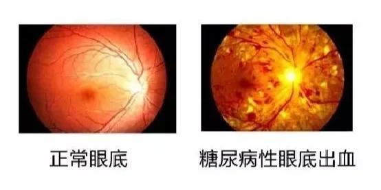 糖尿病并发症中出现率最高的是视网膜不变、肾病和神经的病变，被称为糖尿病的三大并发