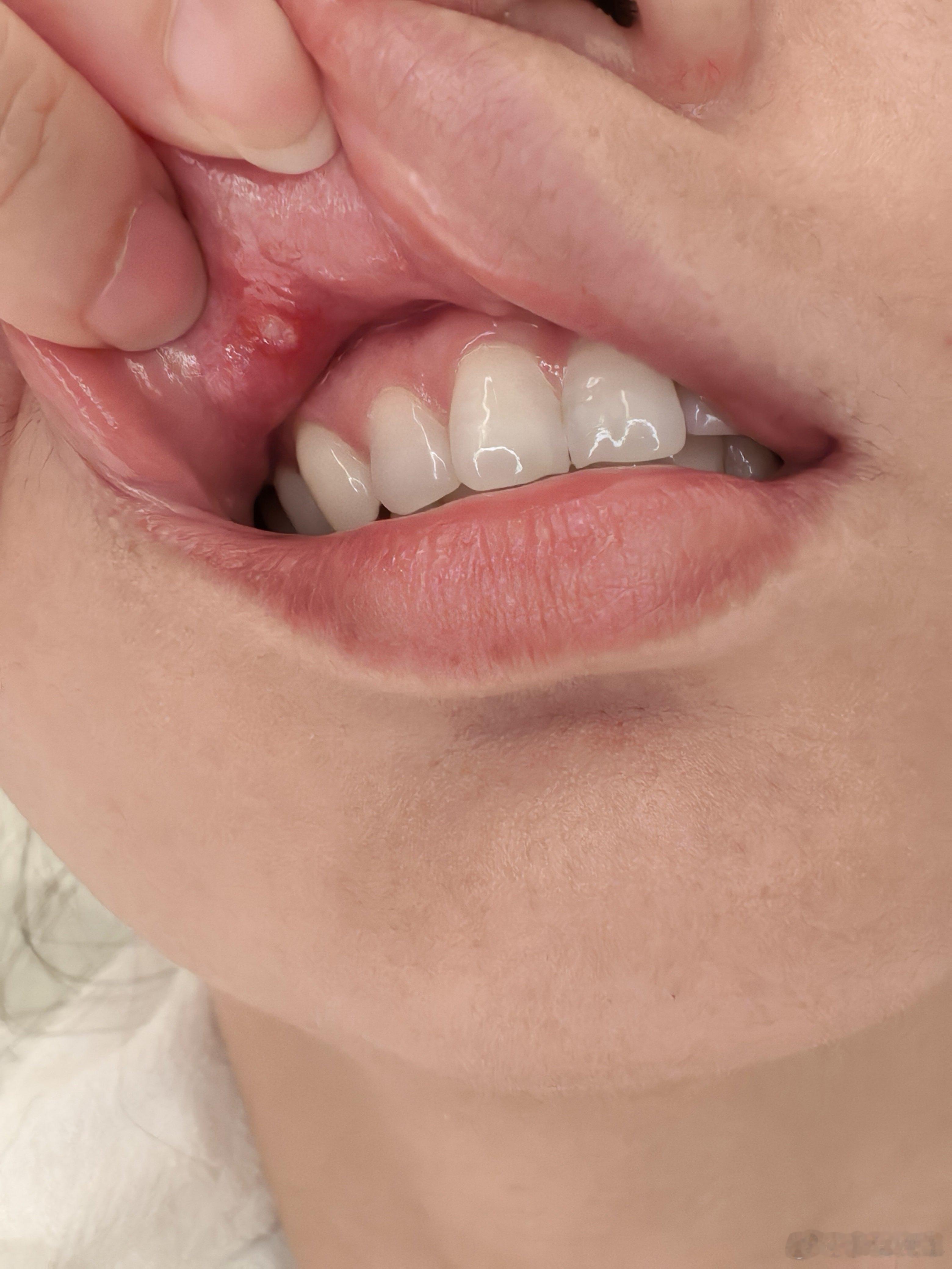 嘴巴里长泡了，两周还没好吃东西好痛，怎么整？