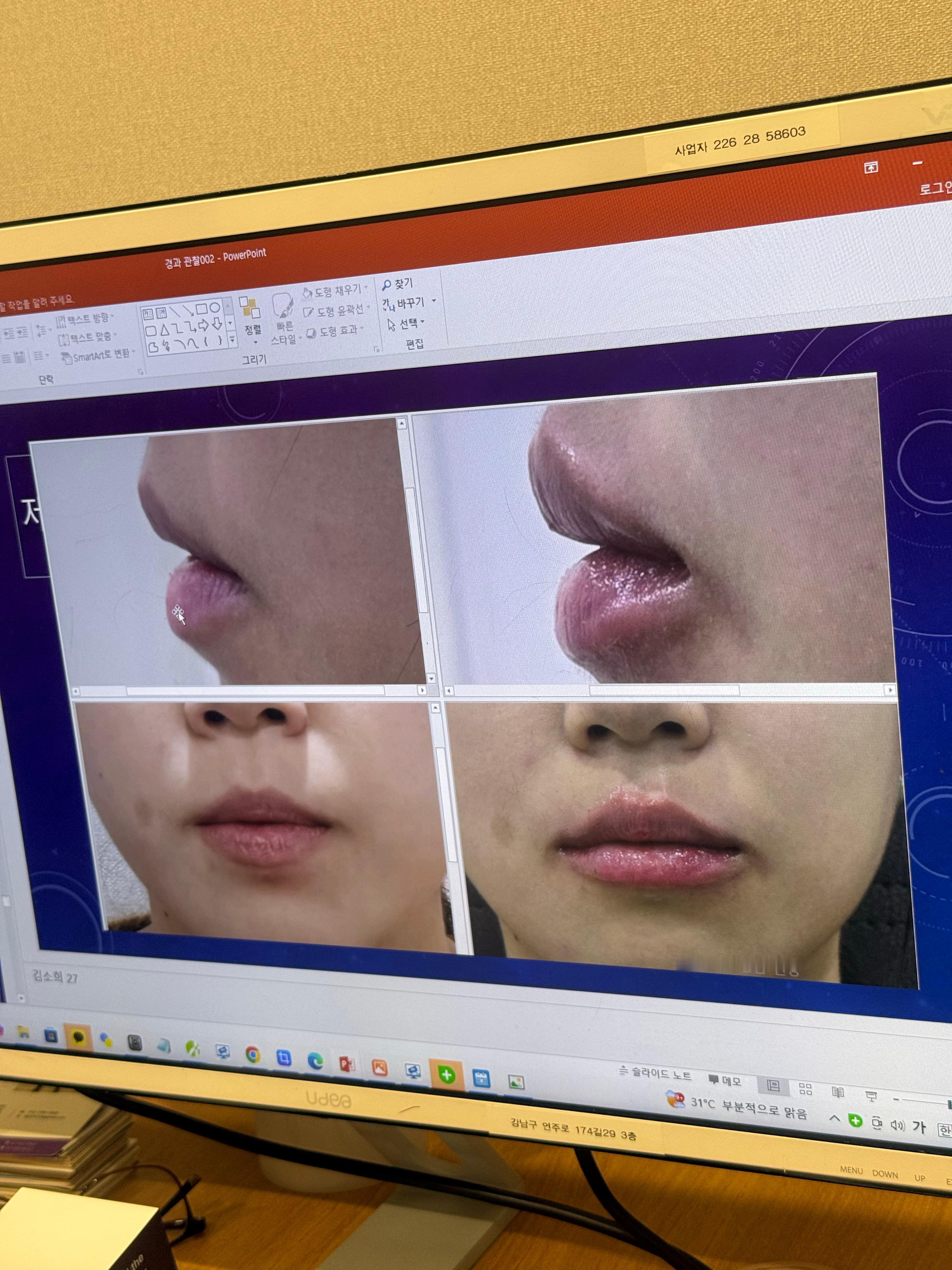 在德莱面诊时候拍的：打卧蚕和嘴巴就是会让人变得更美萌！但不要过度，网感很强的只有