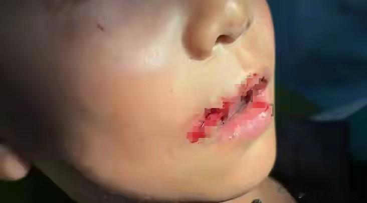 广东广州，9岁男孩在滑板场玩滑板时摔倒，上嘴唇被贯穿，外面缝了3公分，里面还得缝