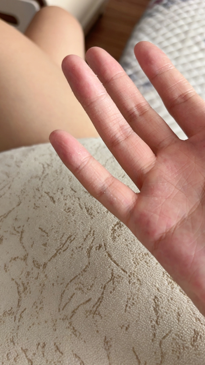 在家倒腾胶水倒腾去污剂不带手套然后我的手就这样了 （我没买给咯咯哒） 