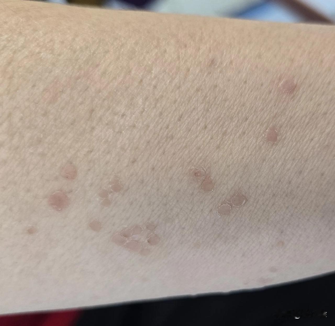 我以前认为中老年女性得扁平疣的概率是不高的，之所以这么认为，我觉得老年女性得老年