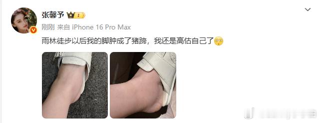 张馨予脚肿成猪蹄张馨予徒步后脚肿了 ​张馨予雨林徒步以后脚肿成了猪蹄 长途徒步还