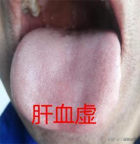 肝不足泪多、心不足汗多、脾不足痰多，中医教你补，五脏不再虚！
肝不足泪多
肝开窍