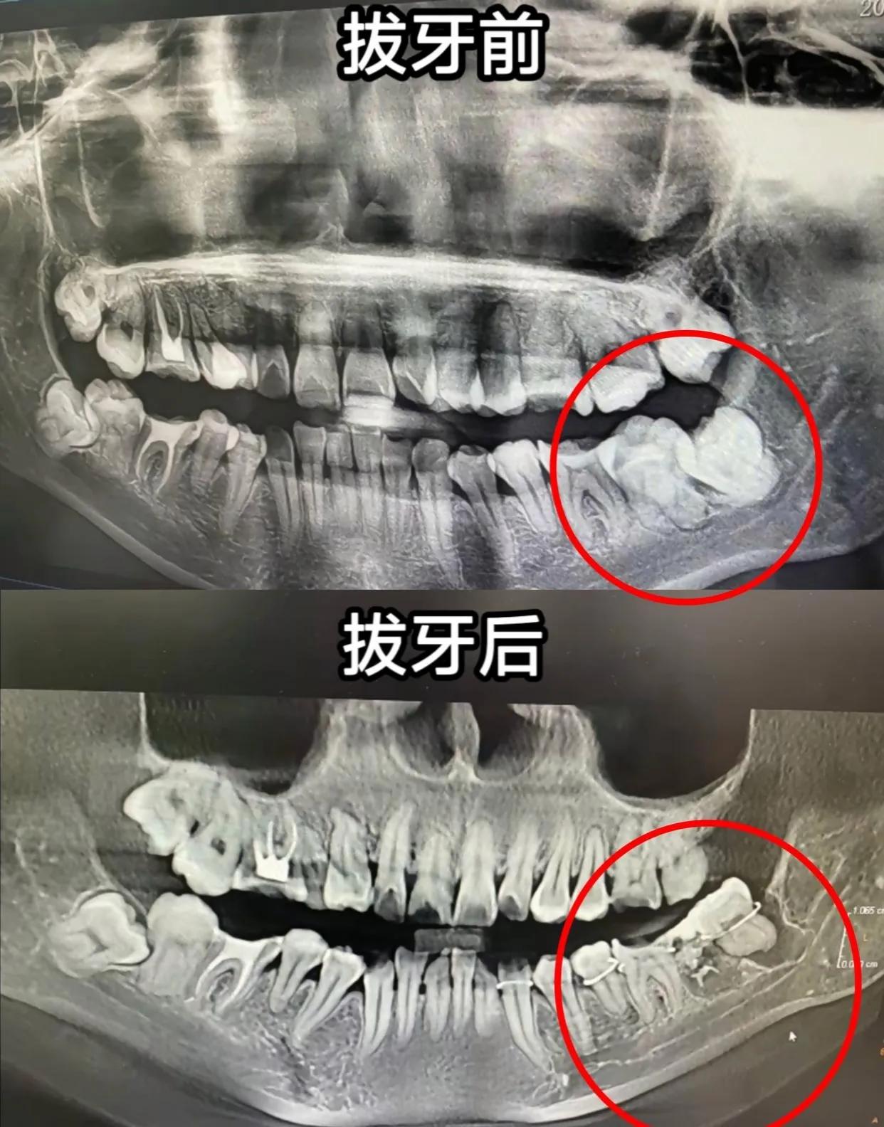 太可怕了，拔牙变拔命，为了一颗牙竟赔上性命？ 

安徽女子吴芳芳因为拔牙去世，年