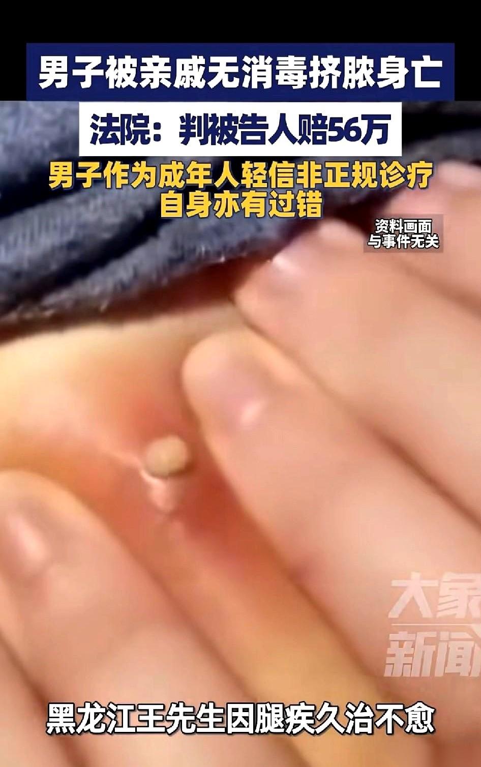 上次看见老公腿上有个火疖子，我手欠直接给硬挤了。
结果没过多久，他整条腿肿得跟发