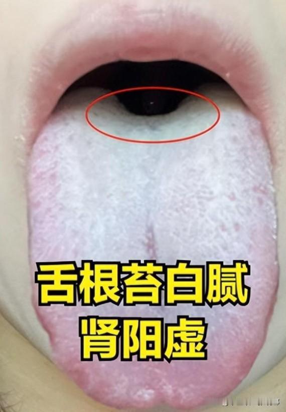 舌根白用桂附，舌根红用六味，舌根黄用二妙（舌根是肾的反射区）

1、舌根白用桂附