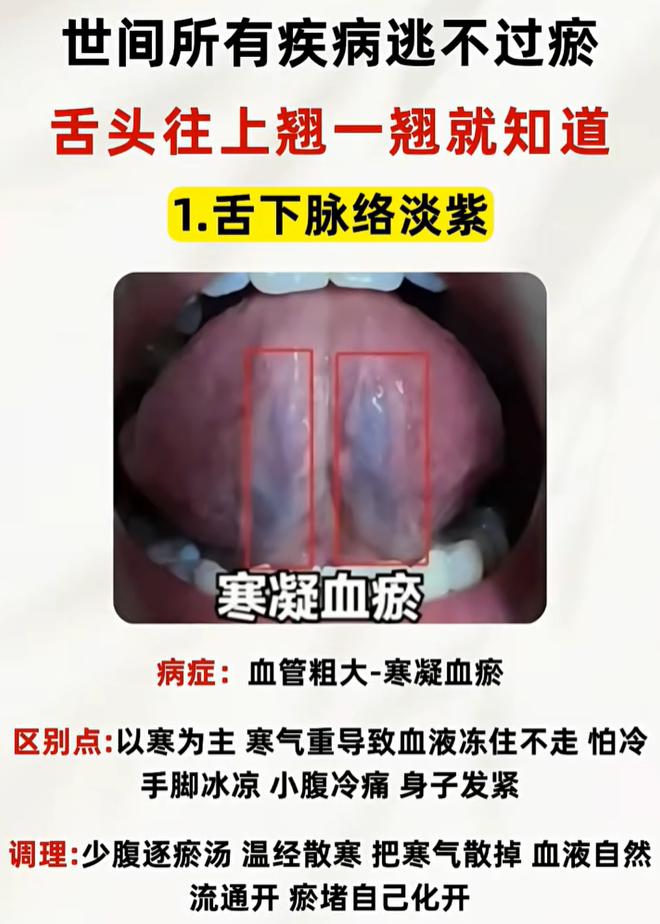 舌诊科普：四种舌下青筋，对应寒凝、气虚、热盛、气滞血瘀
