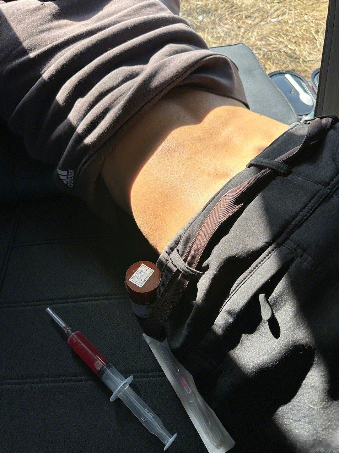 昨日，浦阳江畔，钓友说他腰痛已多年，也曾治疗，因痛背不了钓箱，甚为苦恼。我将他按