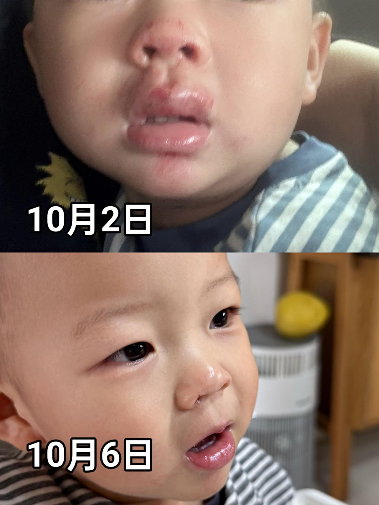 10月2日那天在从推车上摔下来了，车轮卡在缝里，整个车翻了。脸直接撞在农村的糙水