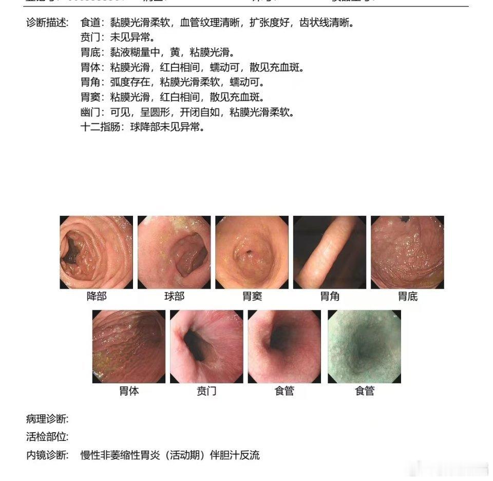 慢性胃炎：绝大部分胃镜报告都是慢性胃炎，是否抑酸，护胃药看症状，当然，最好查HP
