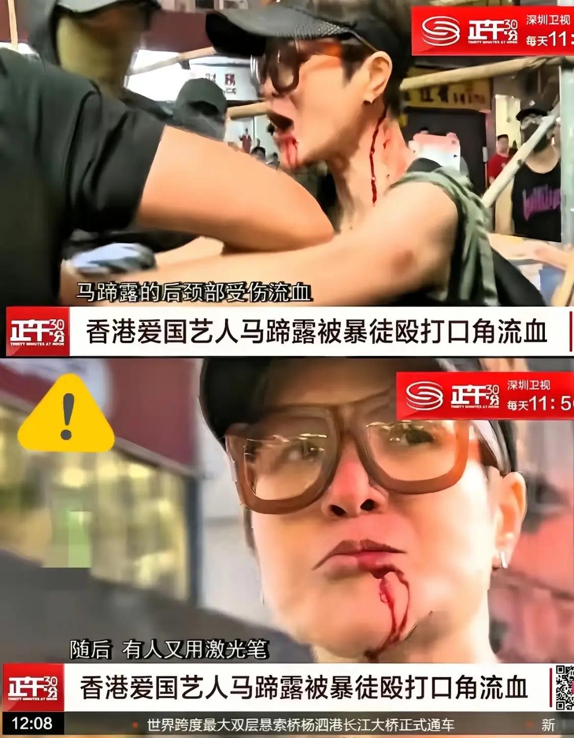 2019年马蹄露作为艺人勇敢站出来爱国，被暴徒打得缝十几针，脸都肿了，采访时说毫