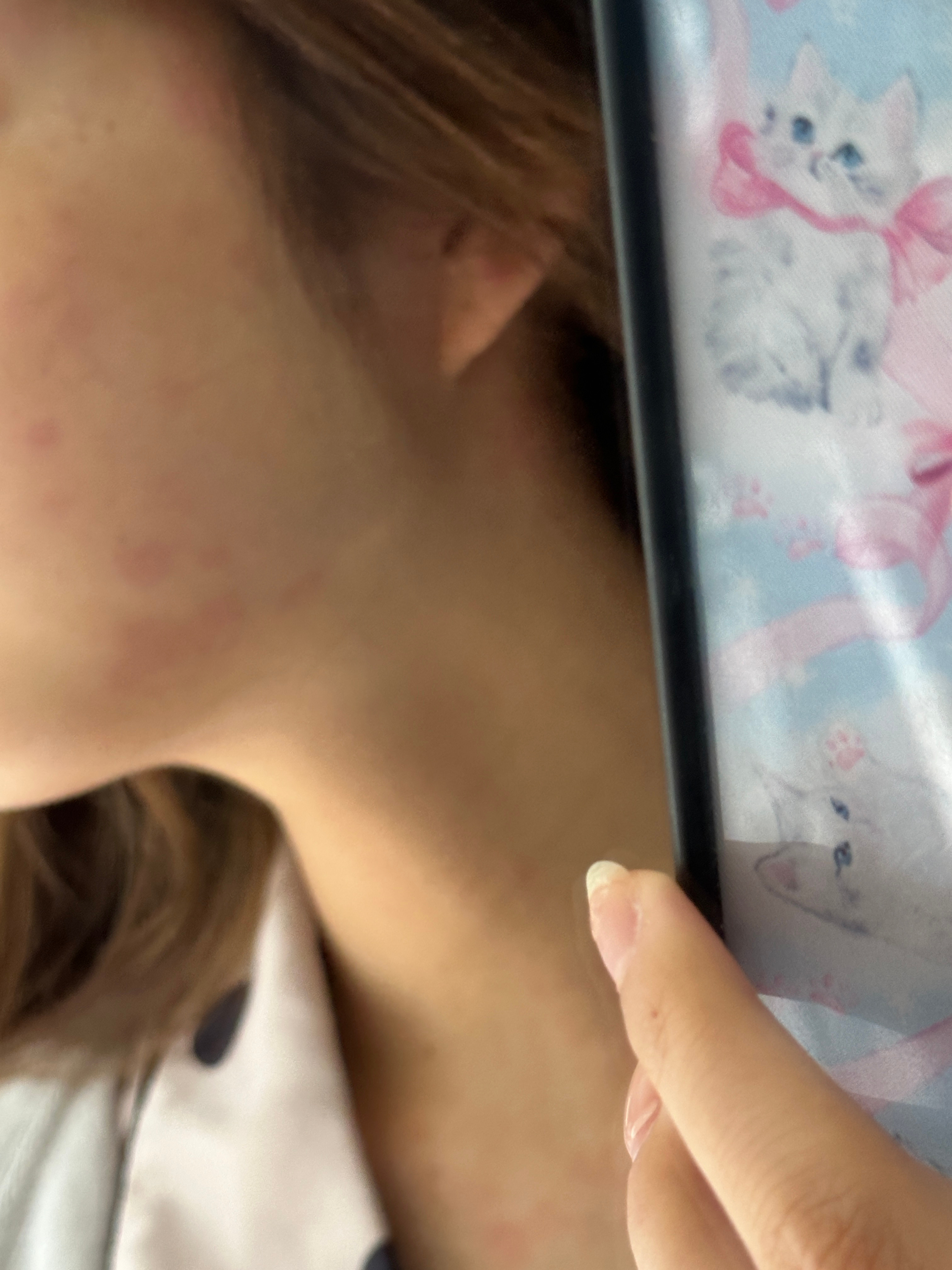 本来今天要给你们播柿子冰茶的……毁如容 寻麻疹还我妈生脸 ​​​