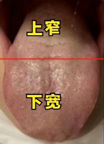 这种舌象你见过吗？特点很明显，上窄下宽。

是一种很经典的脾肾两虚舌象，肾虚尤甚
