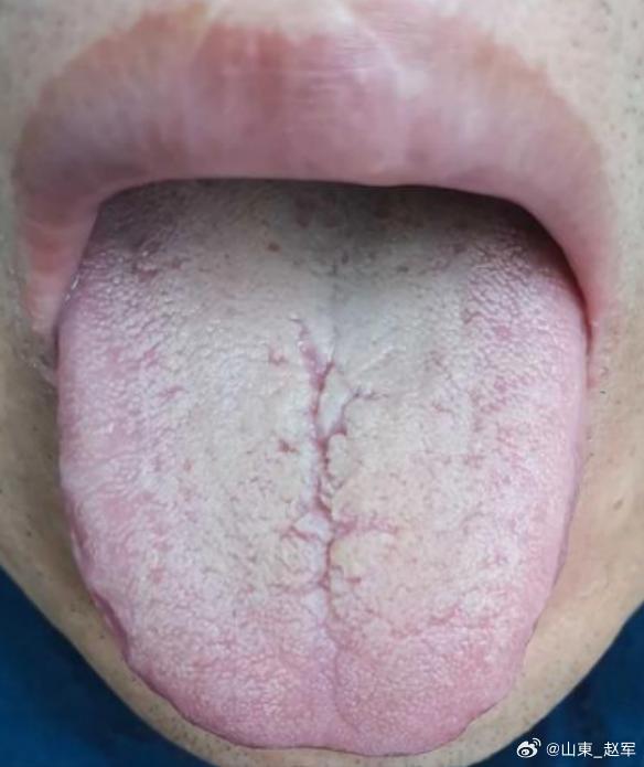 为什么祛湿总反复？现象太真实了：舌苔退了又长、身体轻松两天又沉、痰去了又来。根本