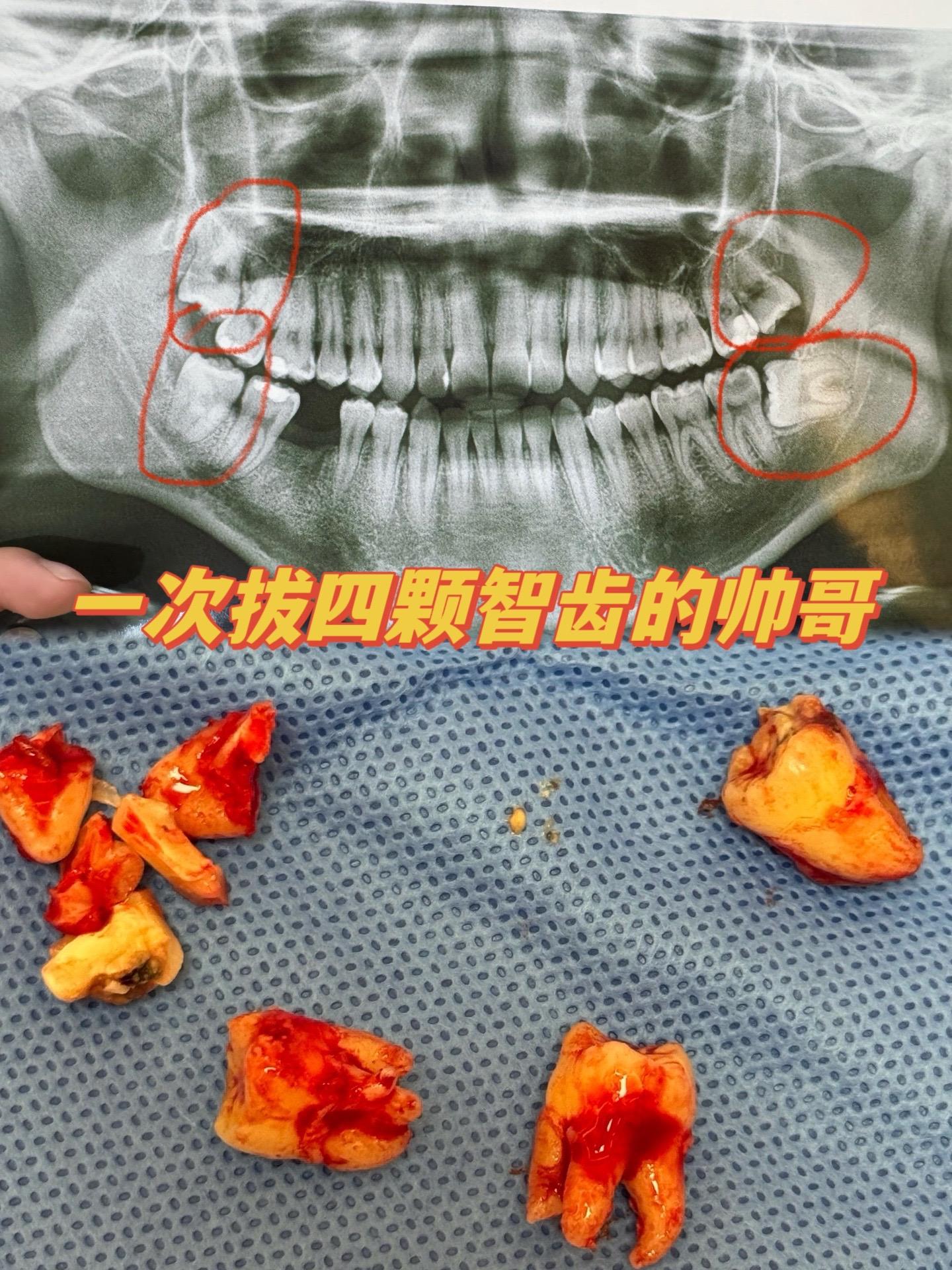 一次拔除四颗智齿的帅哥。小伙子因工作原因，强烈要求一次拔四颗智齿，沟通...