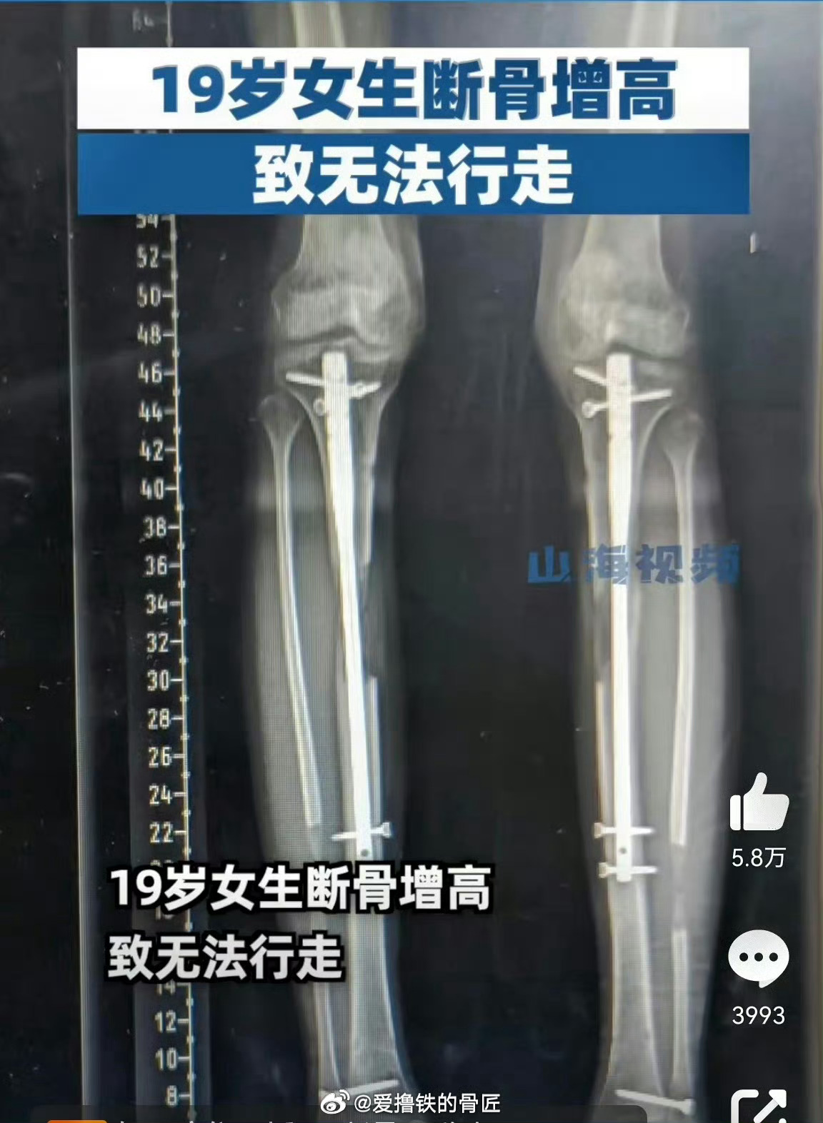 #断骨增高的危害有多大#骨延长增高手术实际上是牵张成骨，常用伊里扎洛夫架通过每天