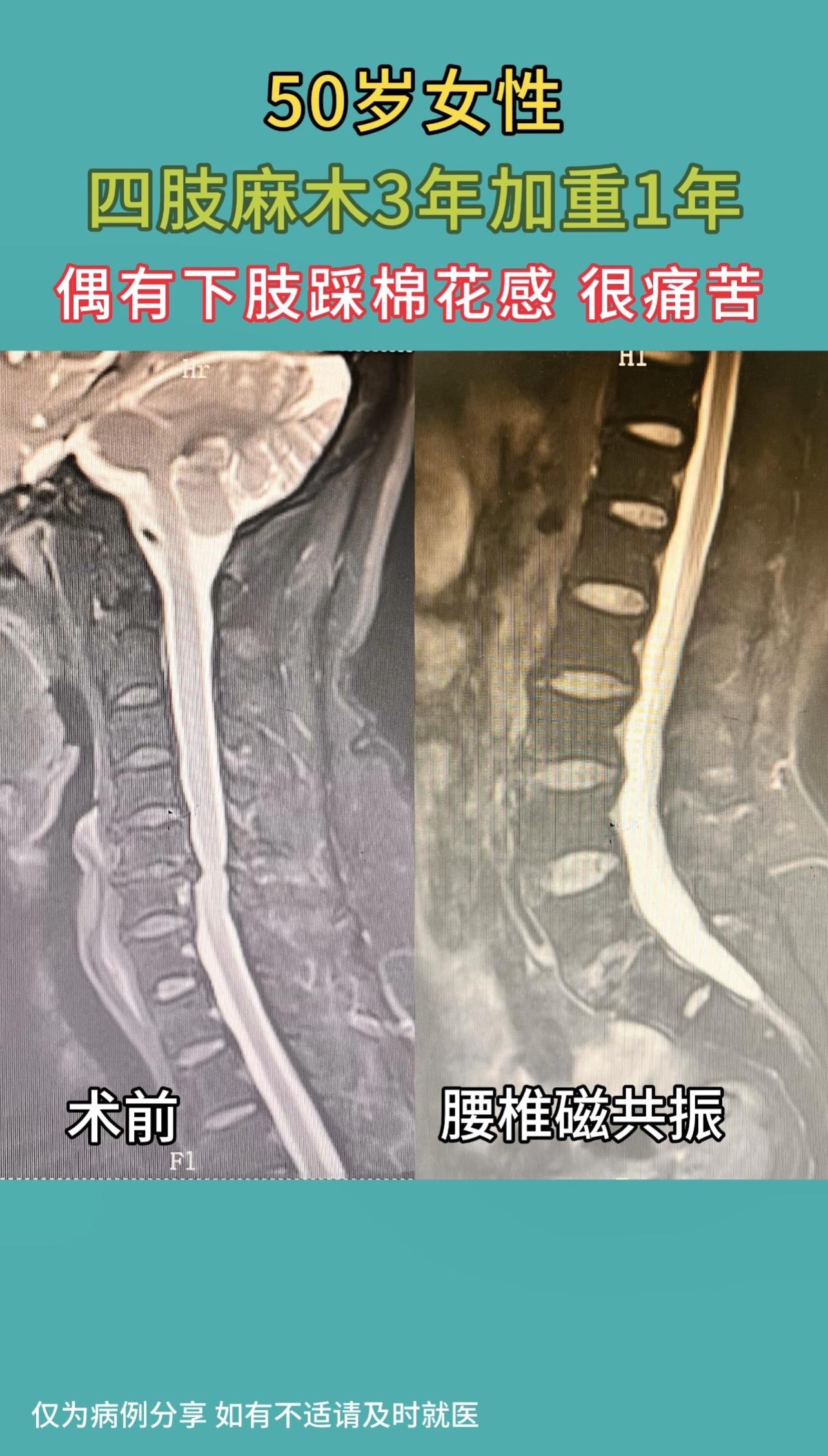 50岁女性，四肢麻木3年加重1年，双下肢重，偶有下肢踩棉花感。患者感觉...