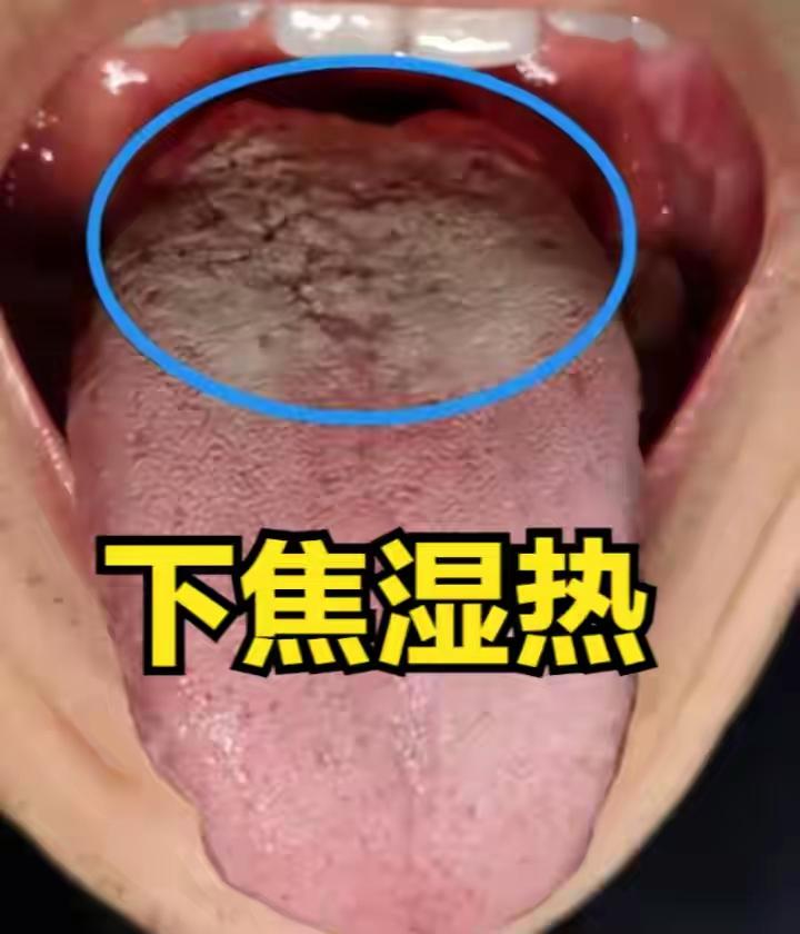 三妙汤+知柏地黄汤：专攻下焦湿热，清湿不伤阴，根源调理
大家好，我是陈大夫。
很