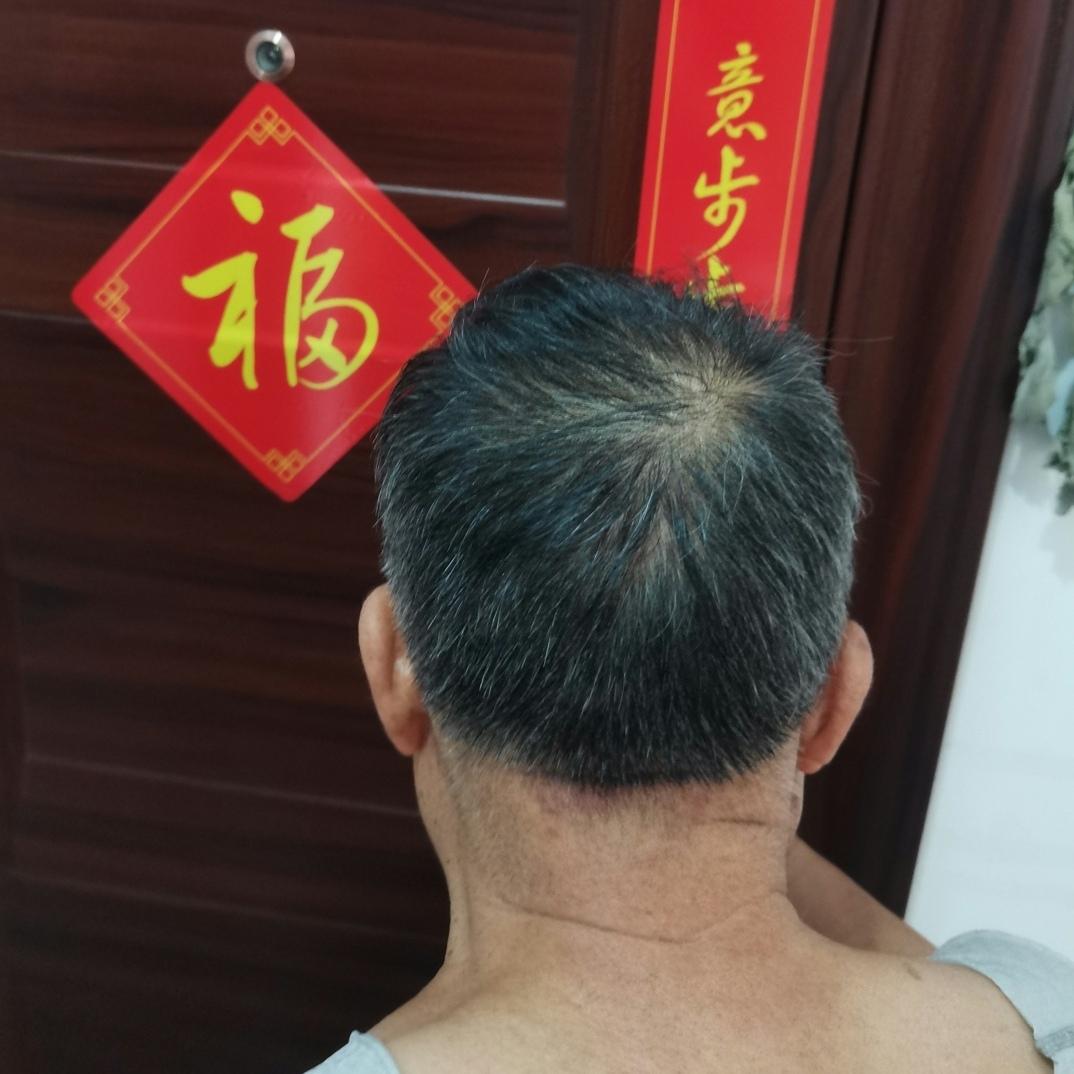 吃黑芝麻养头发 、吃黑豆养头发 、用侧柏叶水洗头养头发，我说这些都不如有个好基因