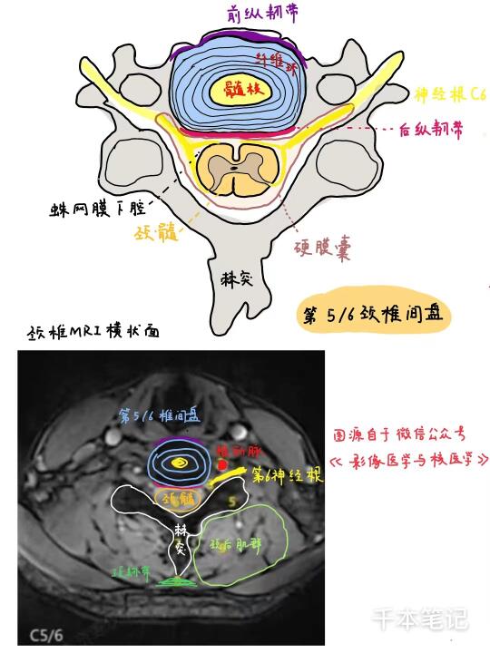 医学生绘本🎨第96弹【颈椎MRI】