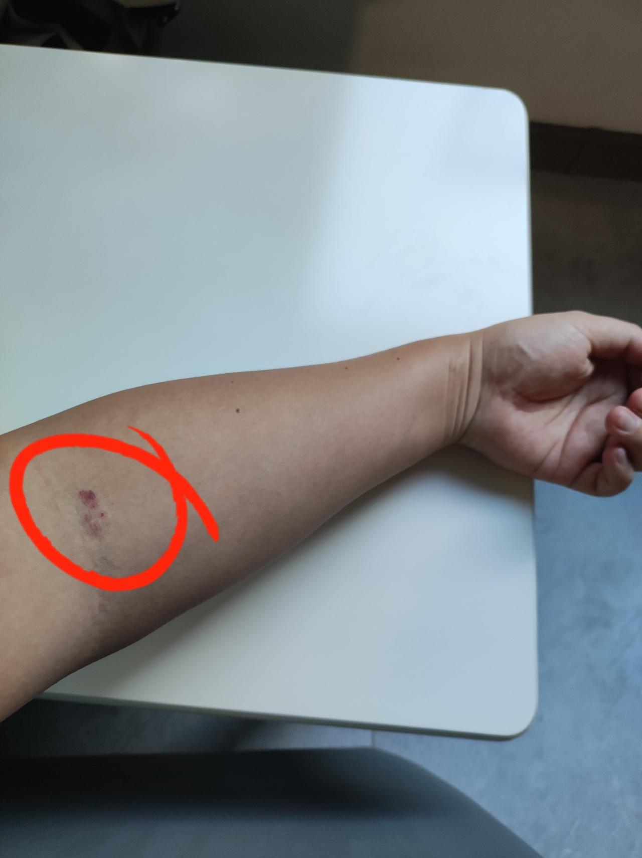 今天去献血小板时，主要是一位实习男护士接待我。他的扎针技术明显还不太熟练，无论是