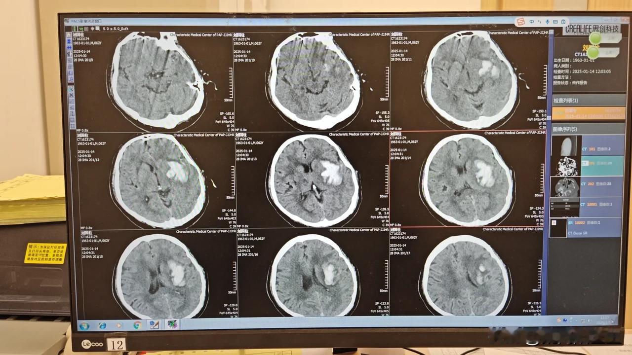 睡醒后发现，
右侧胳膊腿不能活动。
测血压，高压达到200mmHg。
以后估计不