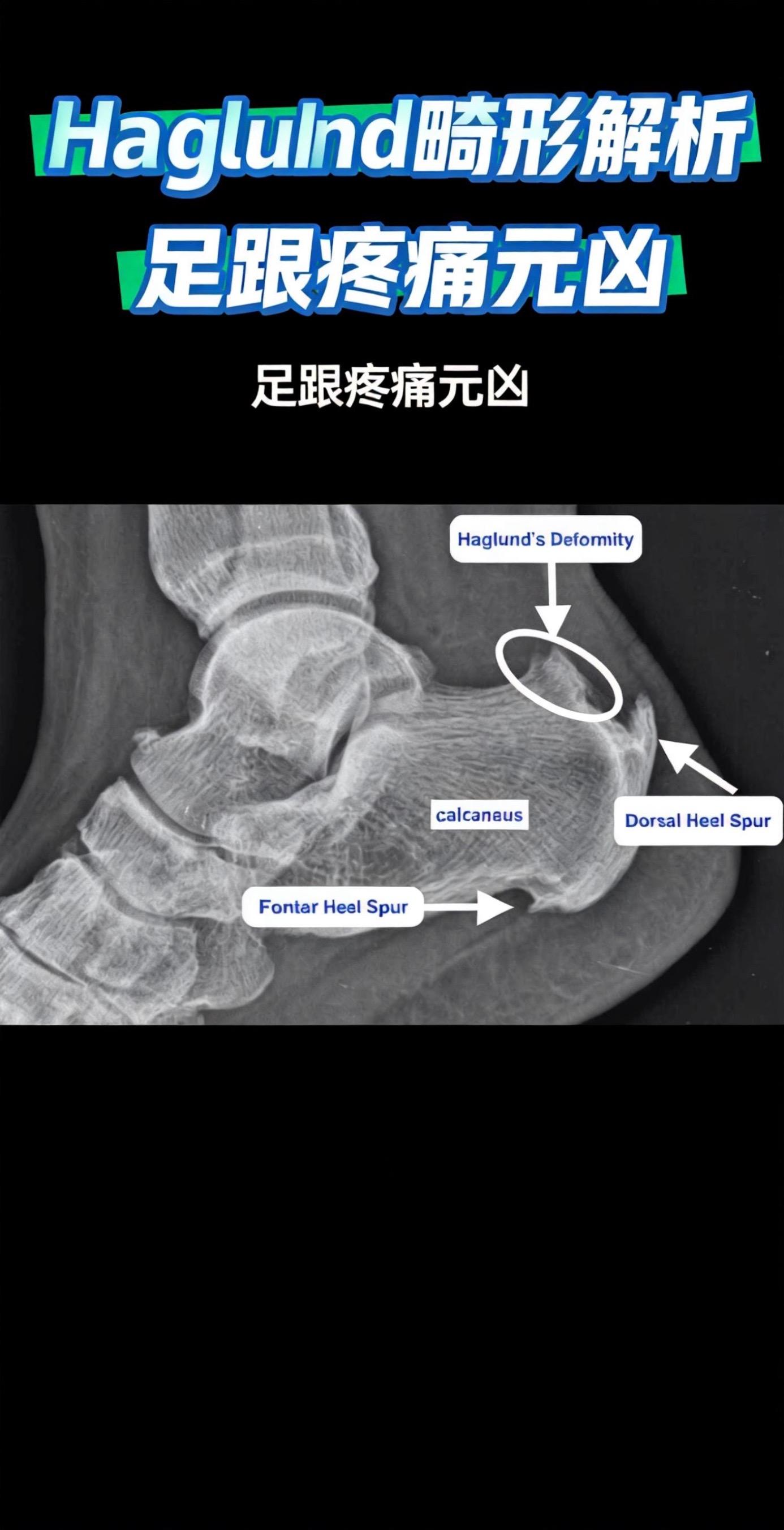 Haglund畸形。切除病变 + 功能重建。
