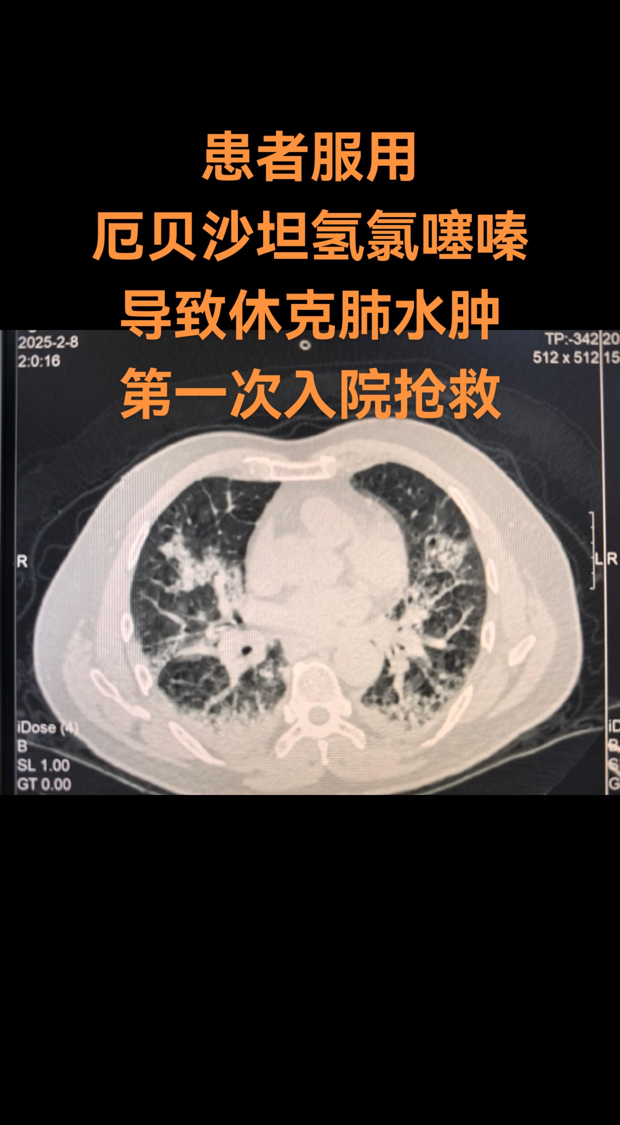 药物性肺水肿。