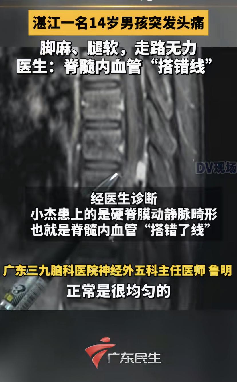 14岁男孩小杰突然头痛欲裂，边叫边扯头发，还带点低烧。家人起初以为是脑炎或脑出血