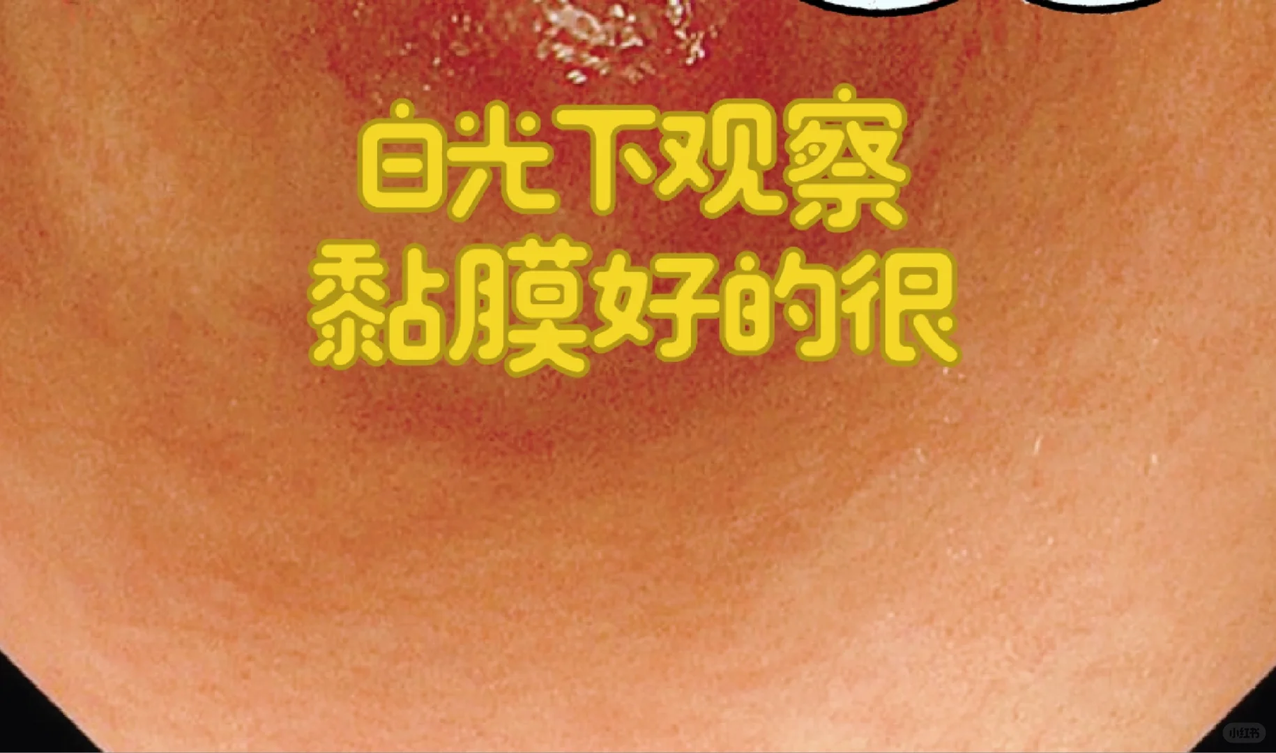 做胃肠镜有时候就像破案子